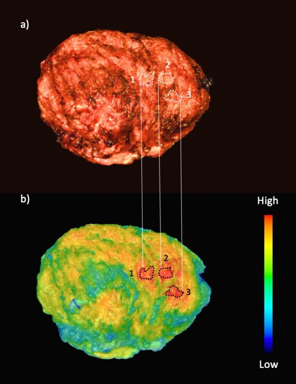 Data from fluorescence imaging can improve outcomes in head and neck cancer surgery: study Data from fluorescence imaging can improve outcomes in head and neck cancer surgery: study