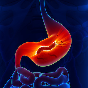 A step toward gastric cancer